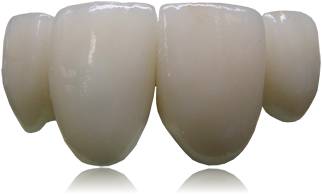 metal free crowns